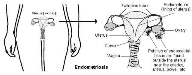 endo 3